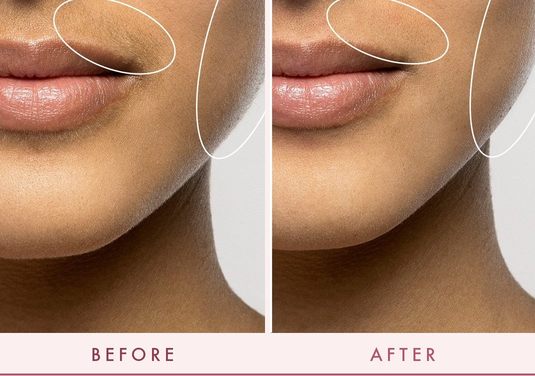Before and after with FLERMIX LUXE+
